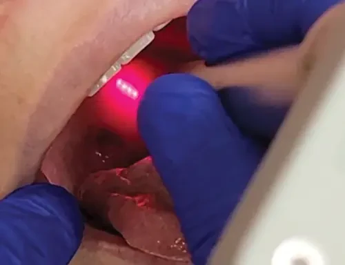 QuietNite laser snoring treatment being performed
