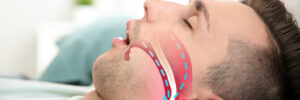 greenville sleep apnea